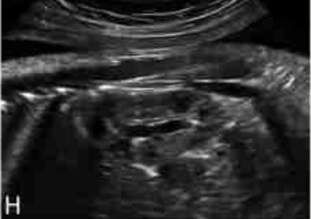 Εμβρυο 32 εβδομάδων . φυσιολογικό νεφρικό παρέγχυμα χωρίς διάταση καλύκων .